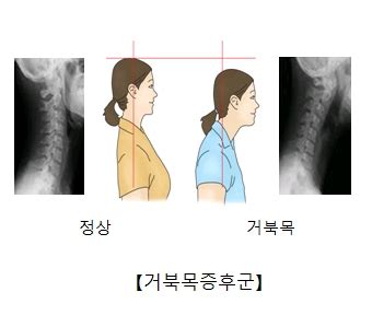 목 통증의 진단과 치료 건강TV 서울아산병원 - 목이 너무 아파요